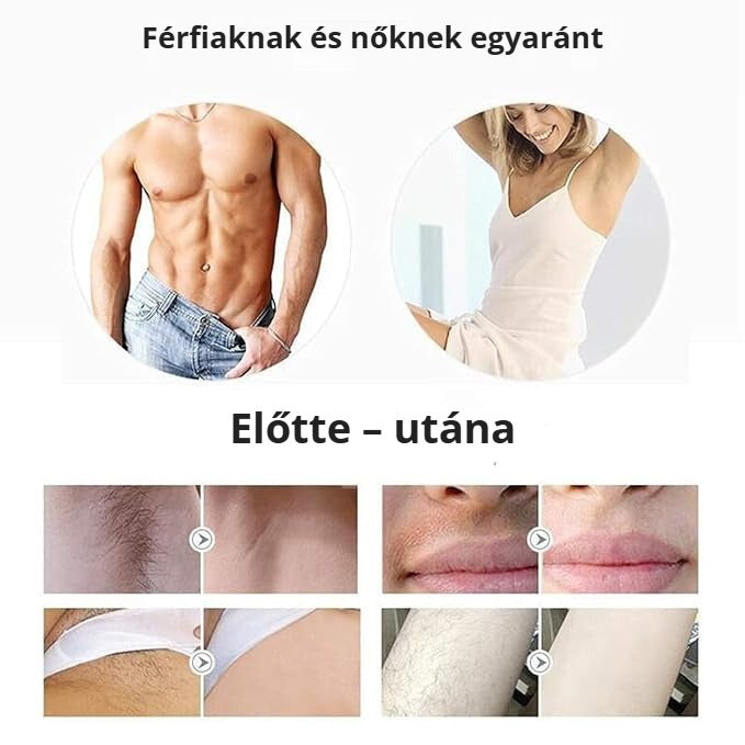 IPL otthoni szőrtelenítő férfiaknak és nőknek – előtte és utána